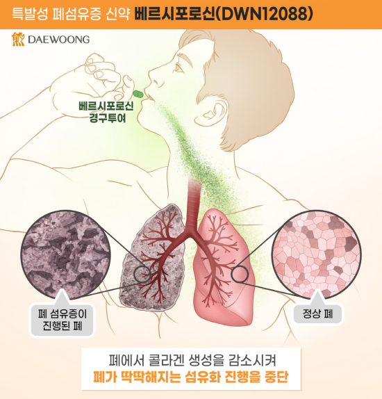 대웅제약, '폐섬유증 신약' 개발 순항…3차 IDMC서 안전성 재확인