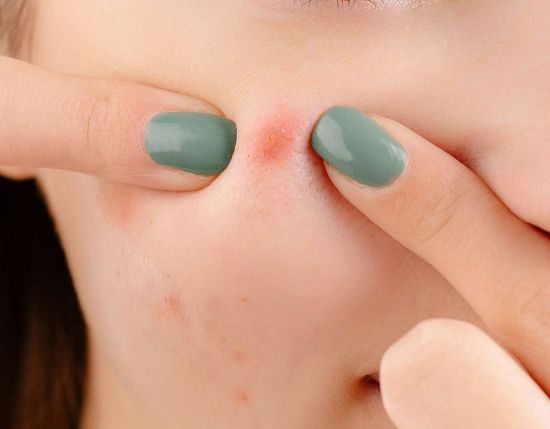 "절대 짜지 마세요" 코·입 주변 여드름 감염 '경고'