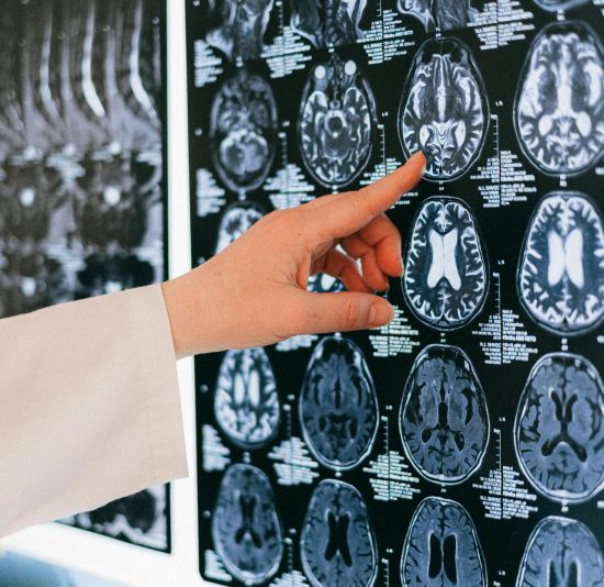 머리 큰 사람들 의문의 1승?…"머리 작고 교육 수준 낮으면 치매위험 쑥"