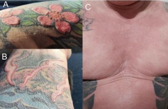 "문신 하나 했을 뿐인데"…전신 탈모에 땀샘 파괴된 30대 남성, 학술지에도 보고