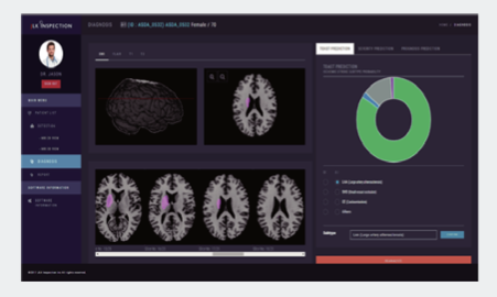 심방세동-뇌졸중 치료 시점, AI가 정밀 예측… 전문의 일치도 87%