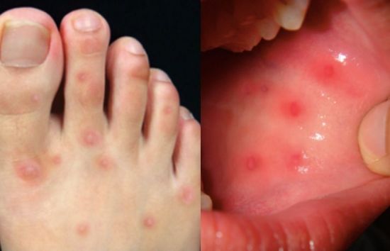 확진 숨기고 학교갔다가 집단감염…"심하면 사망한다" 대만 발칵