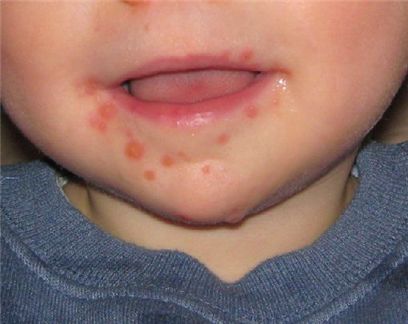 수족구병에 감염된 환아의 입 - 출처 : Wikipedia