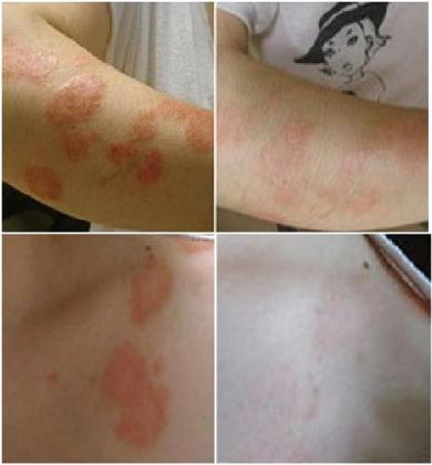 사람 잡는 건선, 건선 잡는 천연화장품