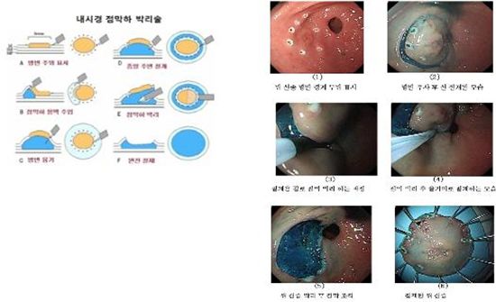 내시경을 이용한 위암·대장암 수술 장면