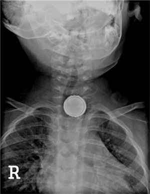 단추모양 리튬전지, 아이가 삼키면 '치명적'