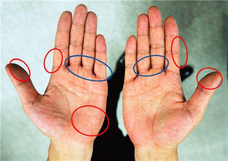  파란 표시 부분에 굳은살이 생기면 그립을 잘 잡았다는 뜻이며 붉은 표시는 잘못된 굳은살이다. 사진=윤동주 기자 doso7@
