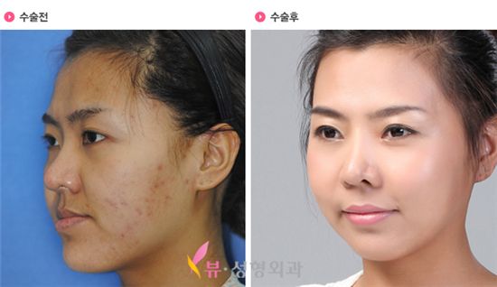 자신감 없던 그녀, 양악수술로 새출발하다