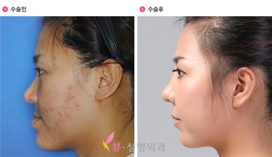 자신감 없던 그녀, 양악수술로 새출발하다