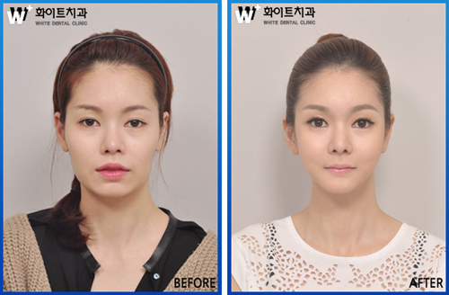 사각턱 양악수술, 3차원 CT로 입체감살려 갸름하게