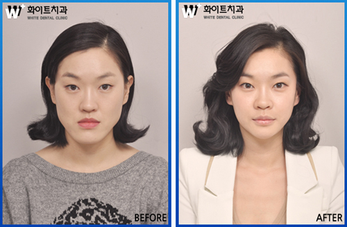 양악수술 '수술계획-집도-교정' 종합플랜이 중요