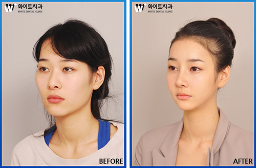 양악수술의 핵심은 자연스러운 턱라인 만들기