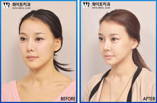 생활 불편 최소화하는 무고정 양악수술