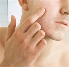 '투명 온열패치'로 여드름 치료한다 