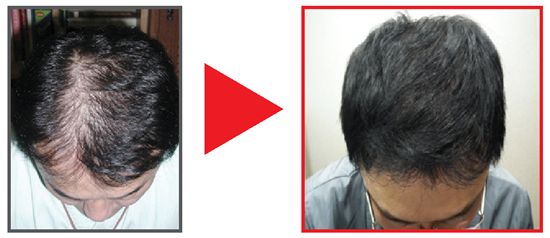 개그맨 권영찬씨는 최근 탈모이식 수술을 통해 탈모 스트레스에서 해방됐다. 사진은 탈모 수술 전(왼쪽)과 후.