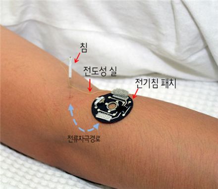 붙이는 초소형 ‘스마트 침’ 나왔다