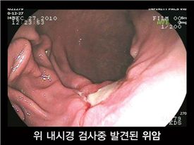위암 검진…'조영촬영'보다 '내시경'이 더 효과