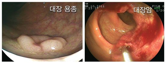 대장암 원인, 잘못된 식습관…'선종성 용종' 환자 매년↑