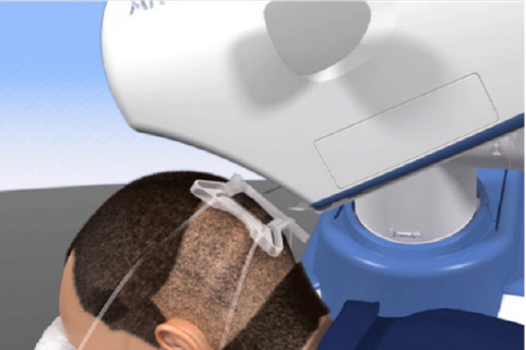 모발이식도 '로봇'이 해주는 시대 도래