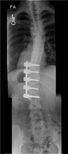  스테이시 루이스의 척추 엑스레이 사진.