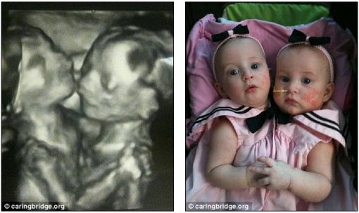 ▲ 쌈쌍둥이 자매 앨리슨 준과 아멜리아 리의 태아 초음파 사진(왼쪽)과 분리수술 전의 모습(오른쪽). 아기 부모는 임신 5개월에 태아에 이상이 있다는 사실을 알았지만 정상적으로 출산했다.
