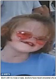 ▲ 눈과 코가 없이 태어난 16살 소녀가  세 차례 걸친 수술을 통해 진짜 코를 갖게 됐다.(출처: 영국 데일리메일) 