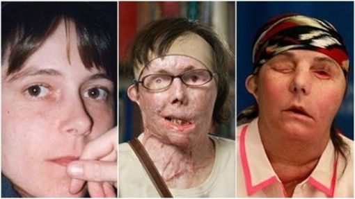 양잿물 뒤집어 쓴 여성, 안면이식 수술로 새 삶