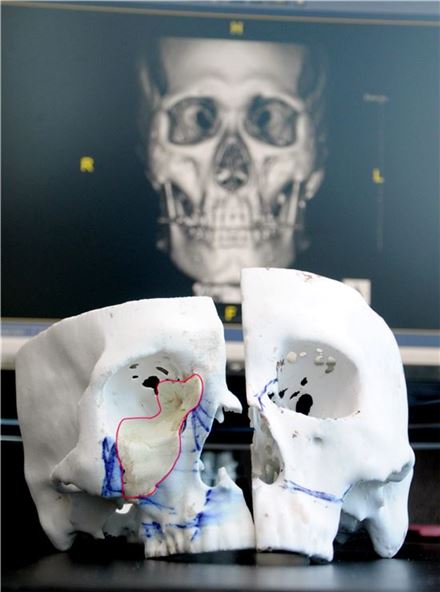 삼성서울병원, '3D프린터' 국내 암 수술에 첫 적용
