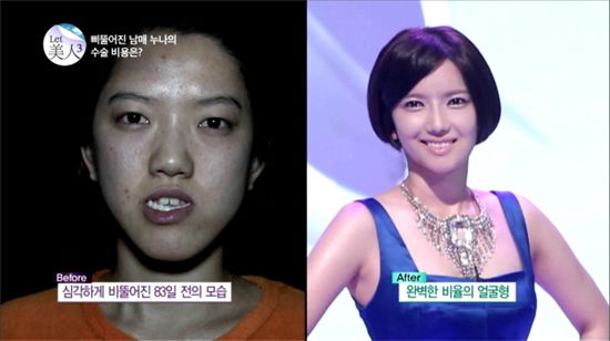 렛미인3 주걱턱효녀 '최지혜', 아나운서 뺨치는 외모 변신