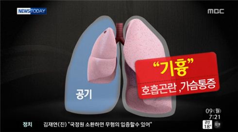 ▲마르고 키가 큰 흡연자가 기흉에 걸릴 가능성이 높다.(출처: MBC뉴스투데이 방송화면 캡처)