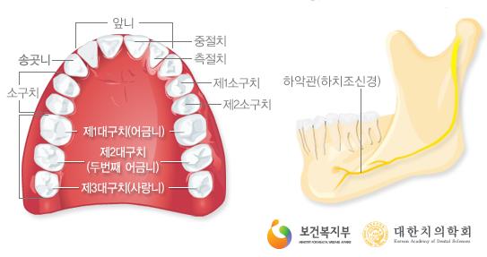 사랑니 발치 후 주의사항…"충분한 휴식과 금주"