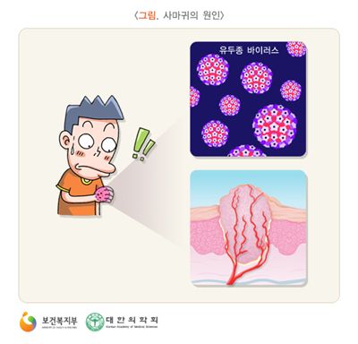 사마귀 생기는 원인, 면역력 저하 때문…'즉시 치료해야'