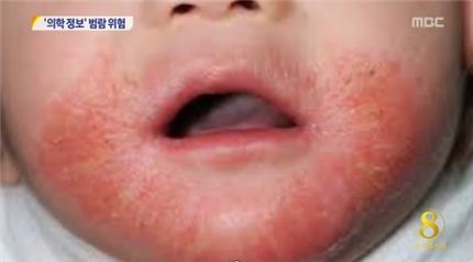 ▲쿠싱증후군(출처: MBC 뉴스데스크)