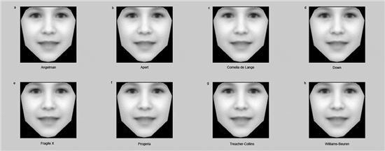 ▲얼굴 사진을 통해 희귀 유전질환에 대한 진단 방법이 만들어졌다.[사진제공=뉴사이언티스트/옥스퍼드 대학]