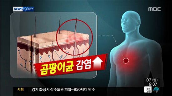 '어루러기' 발병 주의, 여름철 비상…"원인과 예방법은?"
