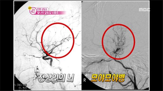 모야모야병, 한국서 발병률 높은 희귀병…성인에겐 뇌출혈 증상