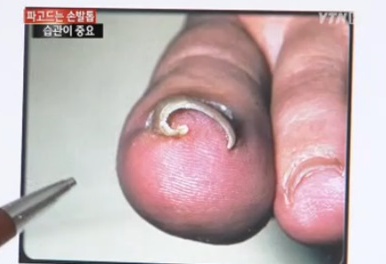 내향성 발톱. 사진=YTN 뉴스 캡처