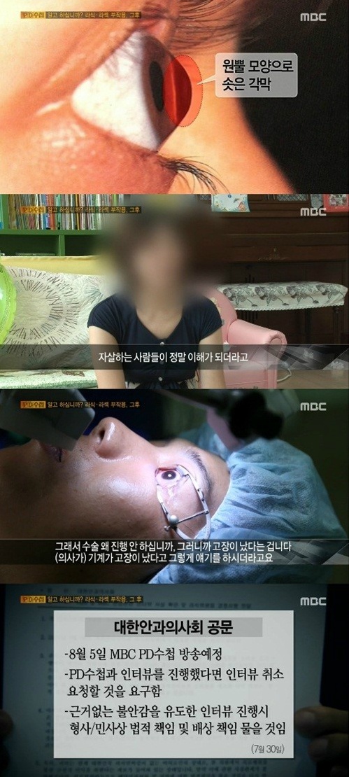 MBC 'PD수첩'에서 라식, 라섹 수술의 부작용에 대해 다뤘다.(사진: MBC 'PD수첩' 캡처)