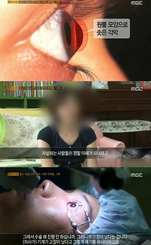 라식, 라섹 등 시력교정수술의 부작용 (사진:MBC 'PD수첩' 방송 캡처)