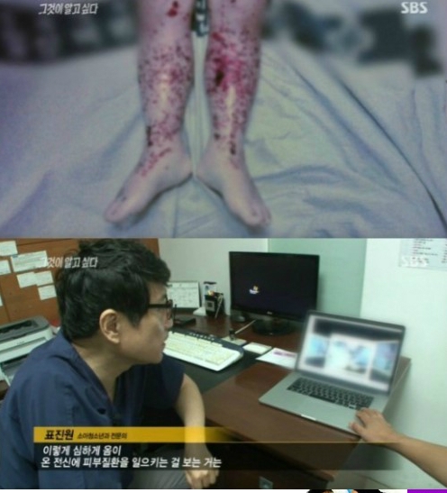 '그것이 알고싶다'에서 공개된 옴으로 사망한 아이 (사진: SBS '그것이 알고싶다' 방송 캡처)