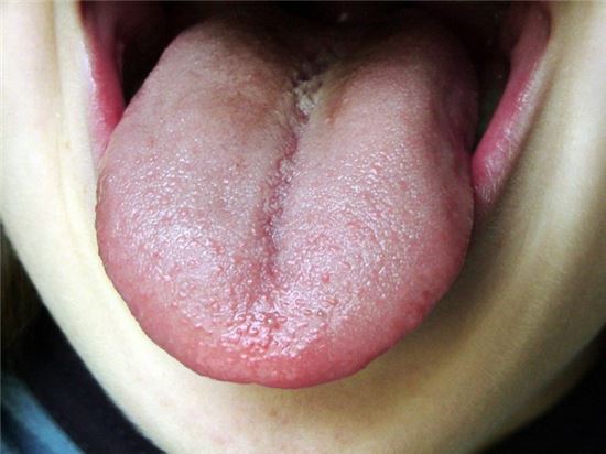 베체트병이란? 면역력 약해지면 급습해…충분한 휴식이 최고