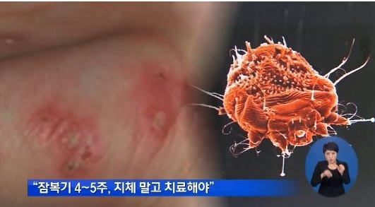 가을철 '옴' 주의보, 전염성 매우 높아… "효과적인 예방법은?"