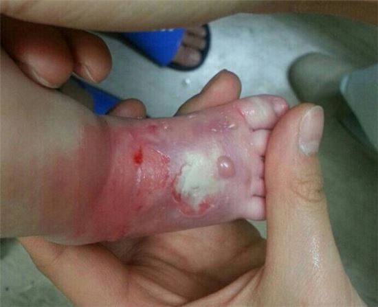 생후 40일 아기 발에 끔찍한 상처…병원 안일 대처에 네티즌 분노 폭발