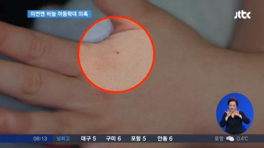 40대 어린이집 여교사 바늘학대…'팔-다리' 상처에도 '모르쇠' 일관