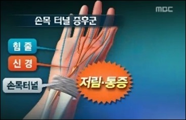 '손목터널증후군' 원인, "손목의 지속·반복적 동작이 원인…스트레칭 필수"