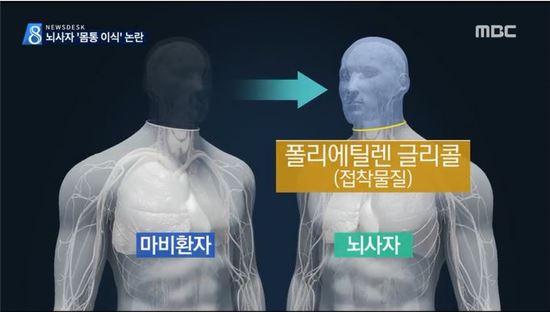 사지마비 환자 '우뚝'…'사람머리 이식'수술 2년 내 현실화되나?