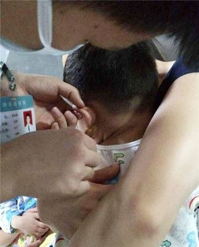 호치키스로 귀가 뚫린 중국 남아. 사진=웨이보