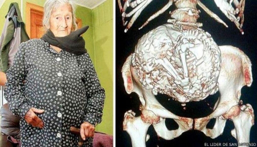 92세 할머니 뱃속에서 발견된 죽은 태아. 사진=영국 데일리메일