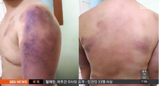 대학생 집단폭행 피의자, 메르스 증세…관련 조사 연기