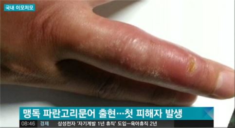 '맹독 문어' 사고 국내서 첫 발생…독성 보니 '깜짝'